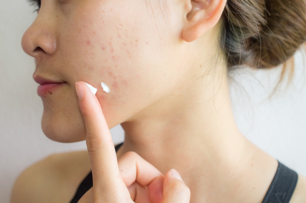 SALICYLIC ACID: WHAT YOU NEED TO KNOW